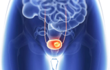 Bladder cancer