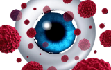 Ocular cancer